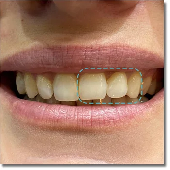 UT ekstremalių 9812mm geriausią estetinį poveikį, cirkonio dantų blokai dantų lab